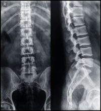Washington state bone fracture injury attorney