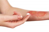 washington state burn injury attorney