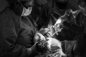 Injury caused during a C-section operation due to medical negligence in Tacoma