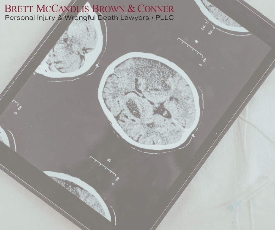 Seattle brain injury lawyer